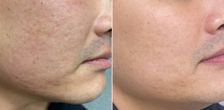Hollywood Spectra Laser Treatment 