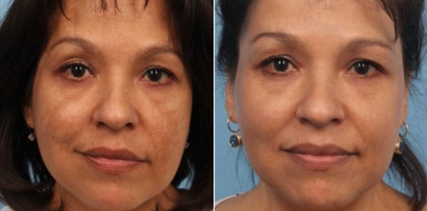 Hollywood Spectra Laser Treatment in 