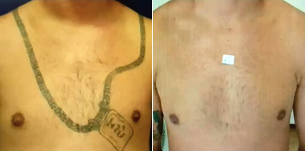 Hollywood Spectra Laser Treatment in 