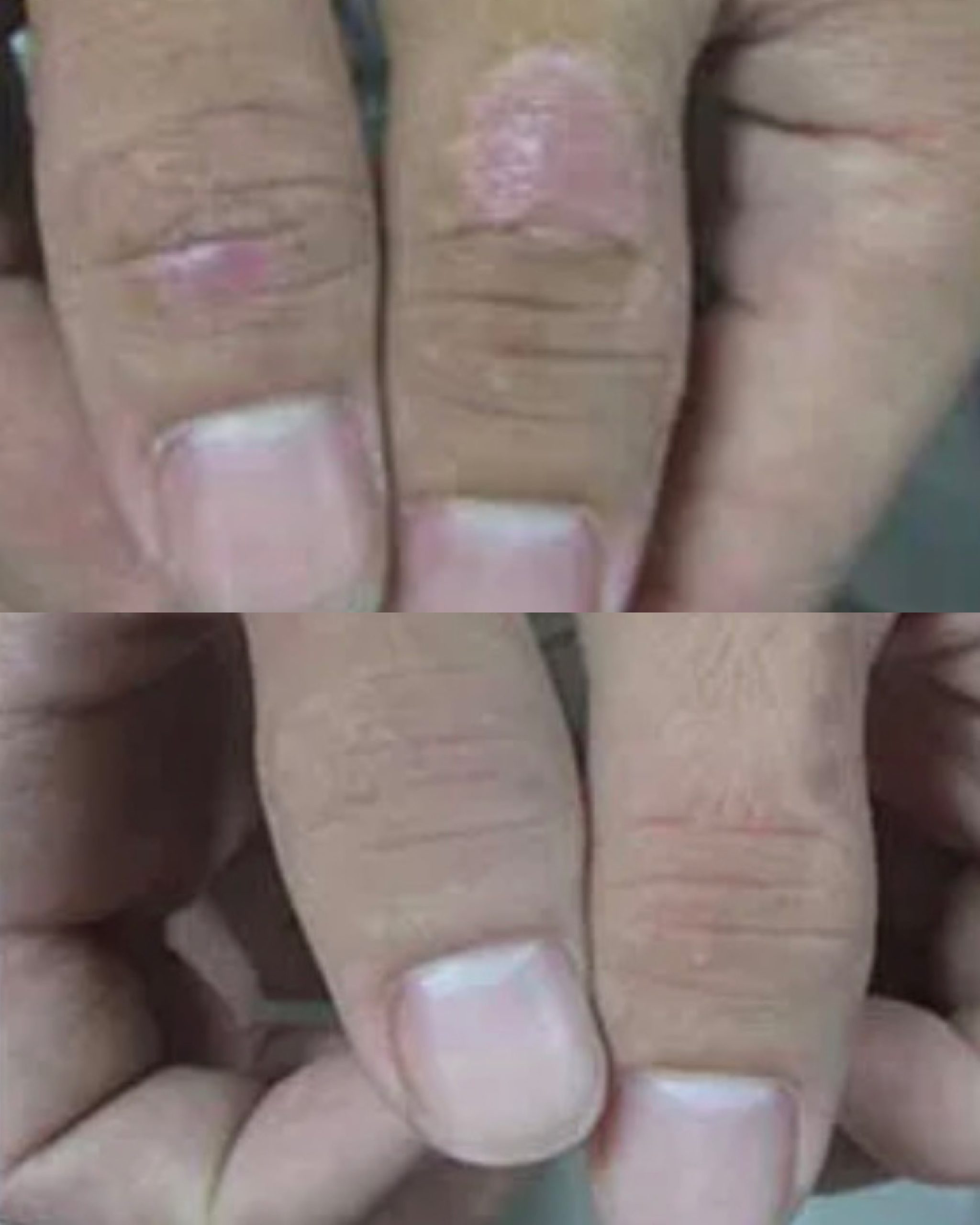 Excimer laser before and after photo 1