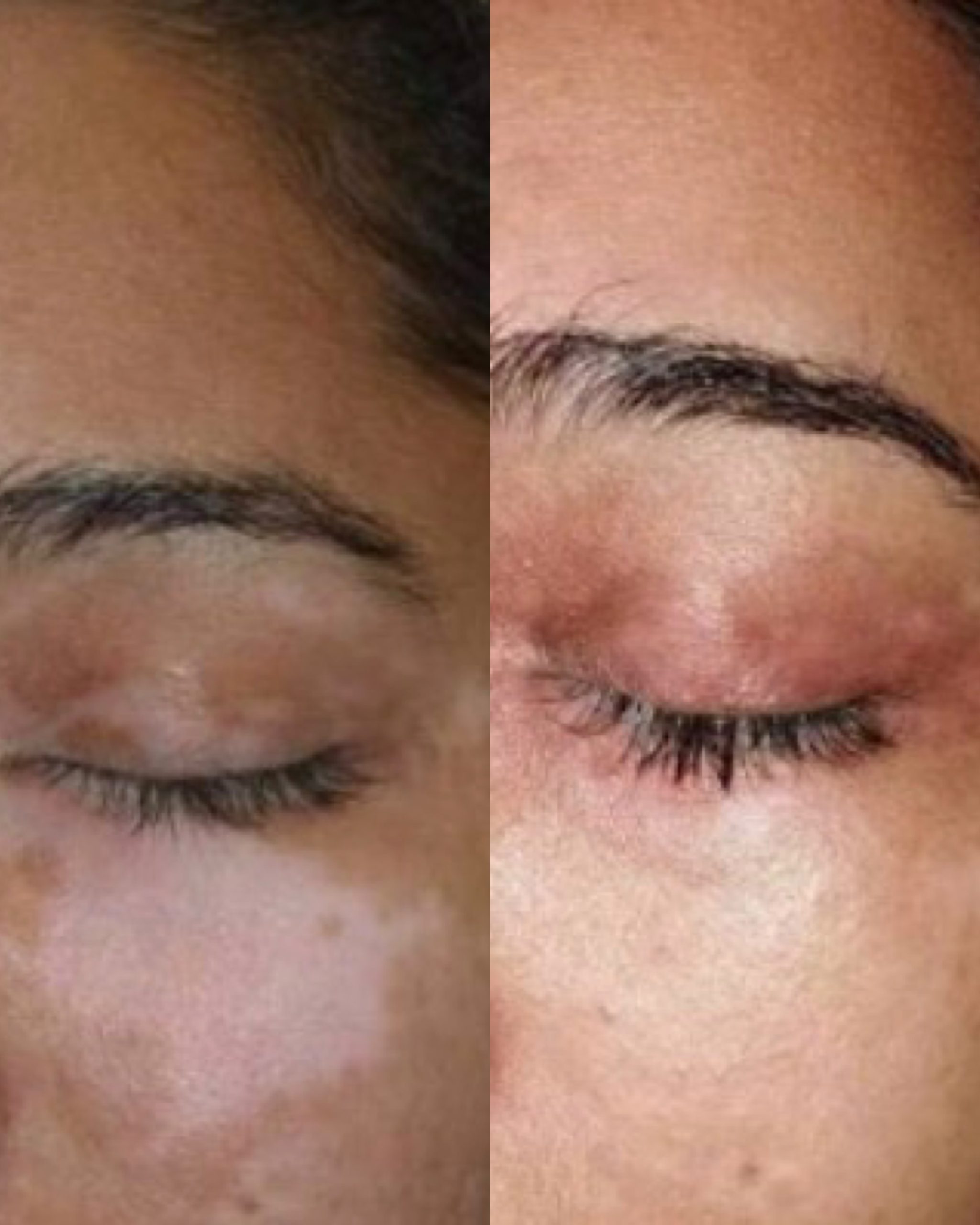 Excimer laser before and after photo 2