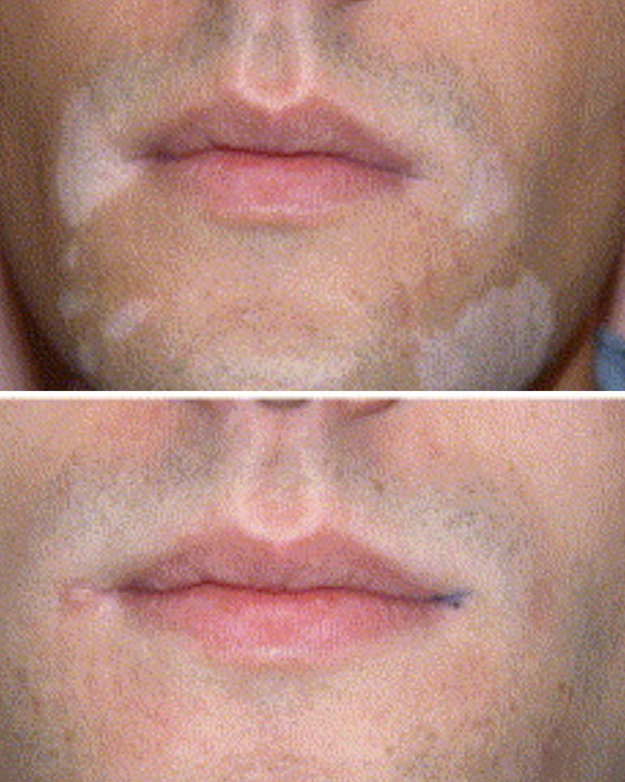 Excimer laser before and after photo 3