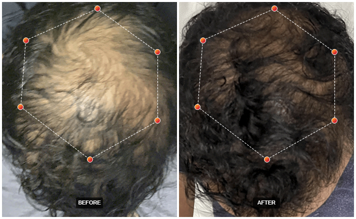 Before and after hair restoration results from REVIAN Red Light Therapy at Dr. Zoë Indigo