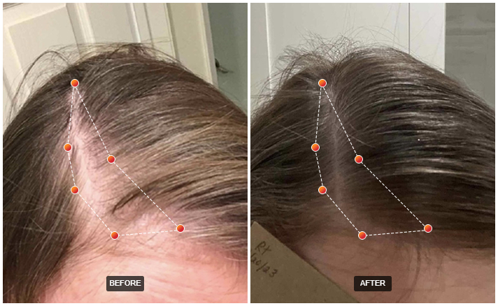 REVIAN Red Light Therapy hair growth before and after comparison with Dr. Zoë Indigo
