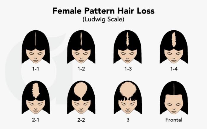 Ludwig Scale diagram showing 3 stages of female pattern hair loss
