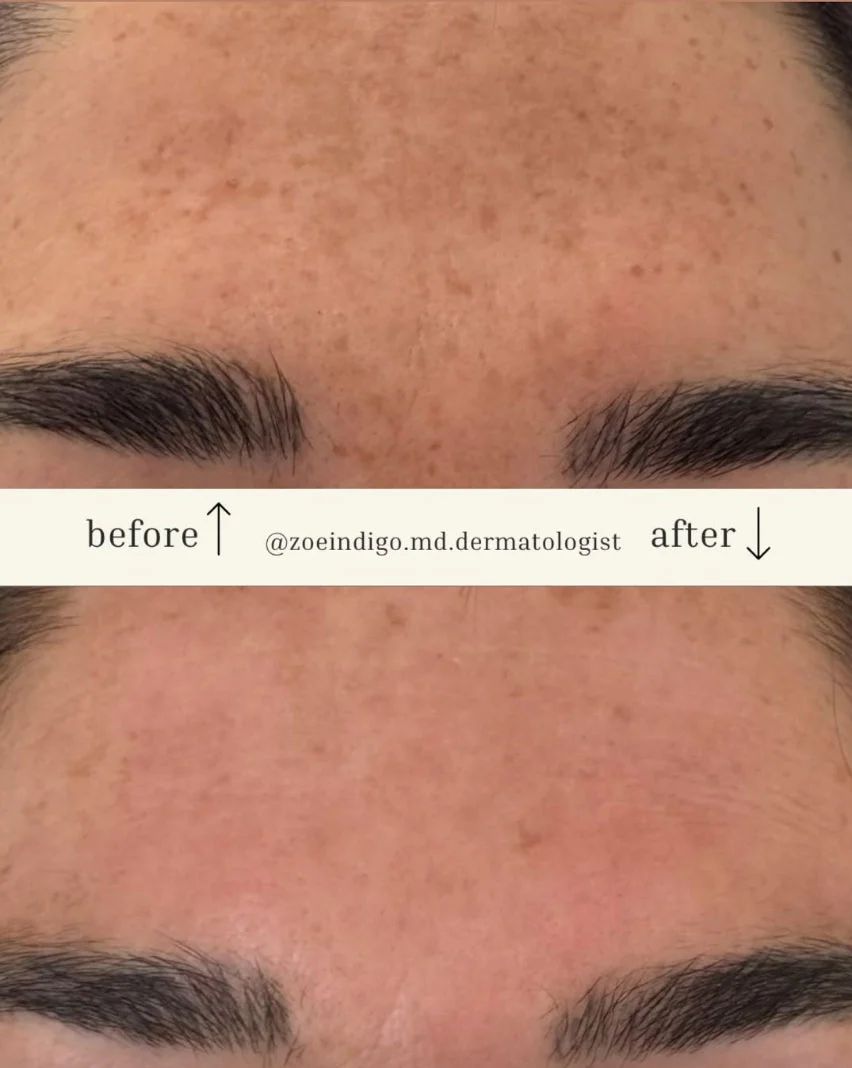 Melasma Treatment in Beverly Hills & LA | Dr. Zoë Indigo