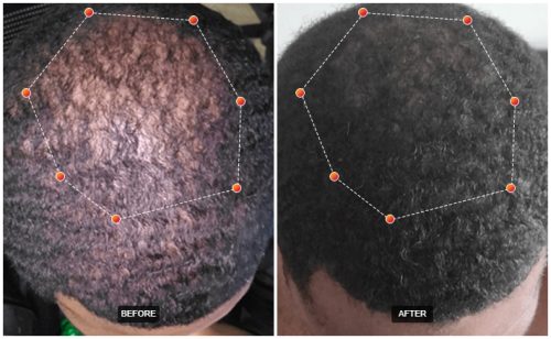REVIAN red light hair therapy before and after treatment results