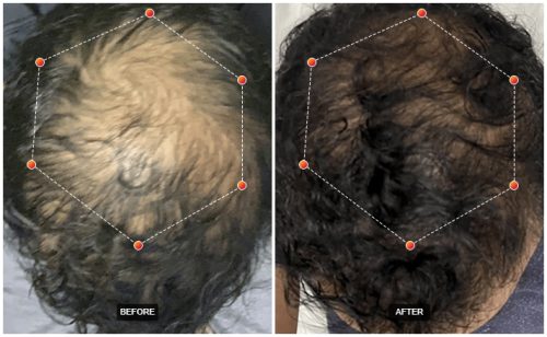 Before and after hair restoration results from REVIAN Red Light Therapy at Dr. Zoë Indigo