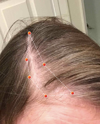 REVIAN Red Light Therapy Before & After