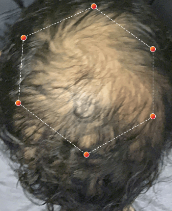 REVIAN Red Light Therapy Before & After