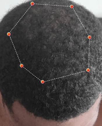 REVIAN Red Light Therapy Before & After
